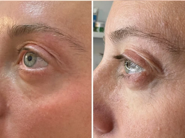 Fibroblast skin tightening treatment — non-surgical skin lift